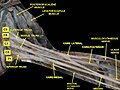 Brachial plexus.Deep dissection.Anterolateral view