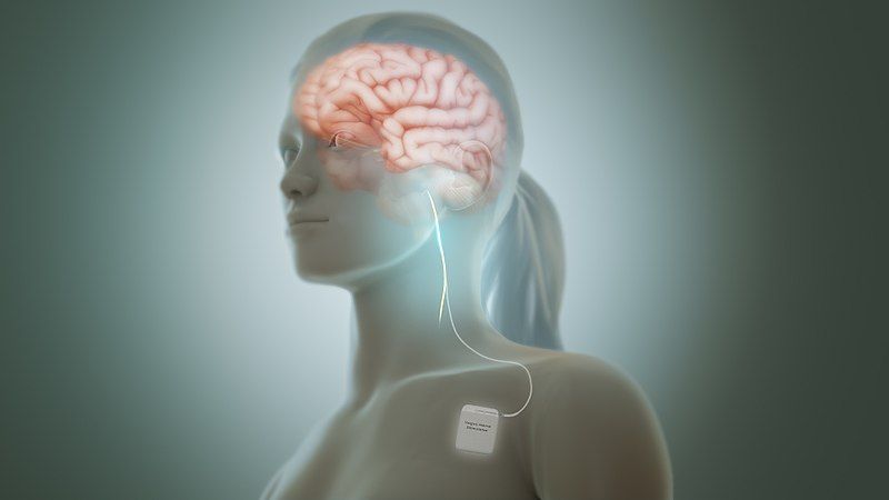 File:Vagus nerve stimulation.jpg