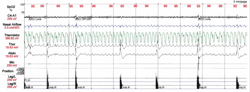 File:PLMD Polysomnogram.png