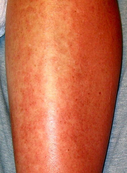 File:Urticaria 2.jpg