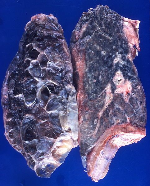 File:Bullous emphysema (4858473626).jpg