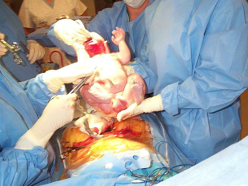 File:Caesarian.jpg