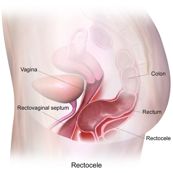 File:Rectocele Diagram.png