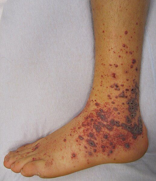 File:Vasculitis.JPG