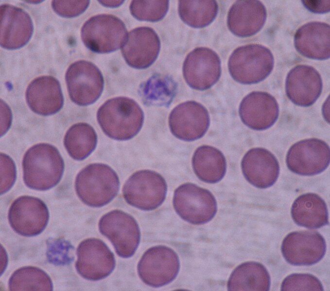 File:Giant platelets.JPG