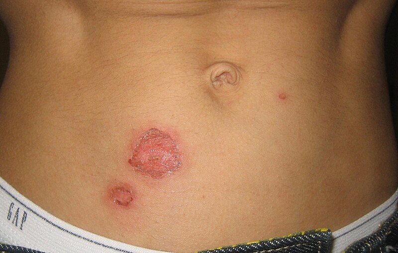 File:Bullous impetigo1.jpg