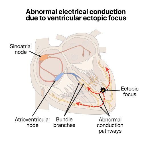 File:Ectopic focus.svg