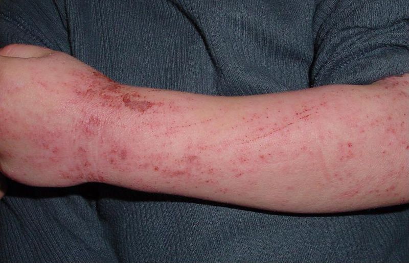 File:Atopic dermatitis child.JPG