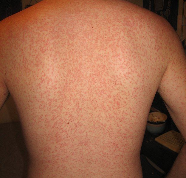 File:Cross Reaction Rash.JPG