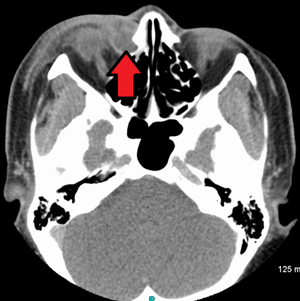 File:Dacryocystitis2017.png