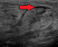 Submandibular gland inflammation as seen on ultrasound