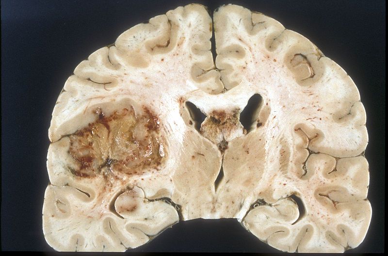 File:Glioblastoma macro.jpg