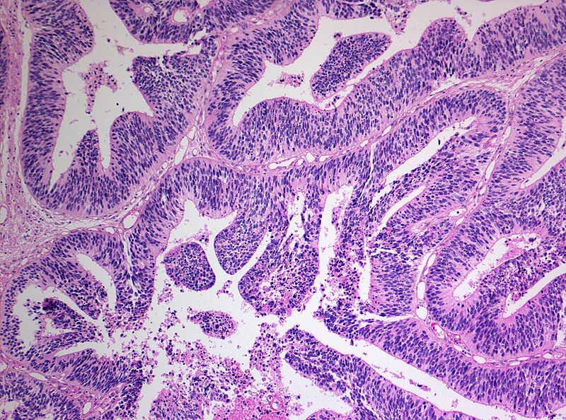 File:Medulloepithelioma Histology.jpg