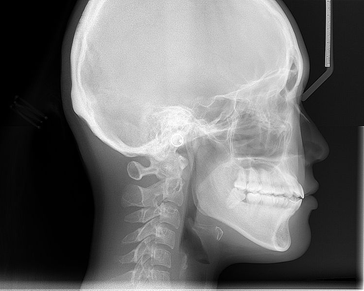 File:Cephalometric radiograph.JPG