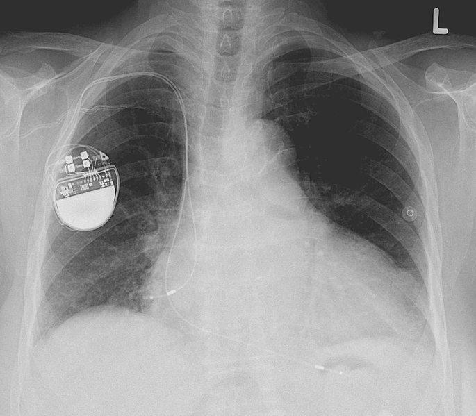 File:Pacemaker.jpg