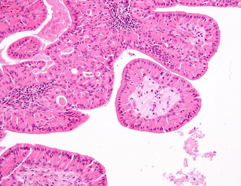 File:Papillary cystadenoma lymphomatosum3.jpg