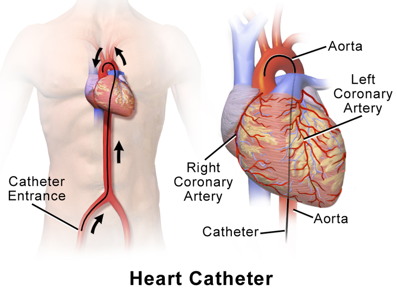 File:Heart Catheter.png