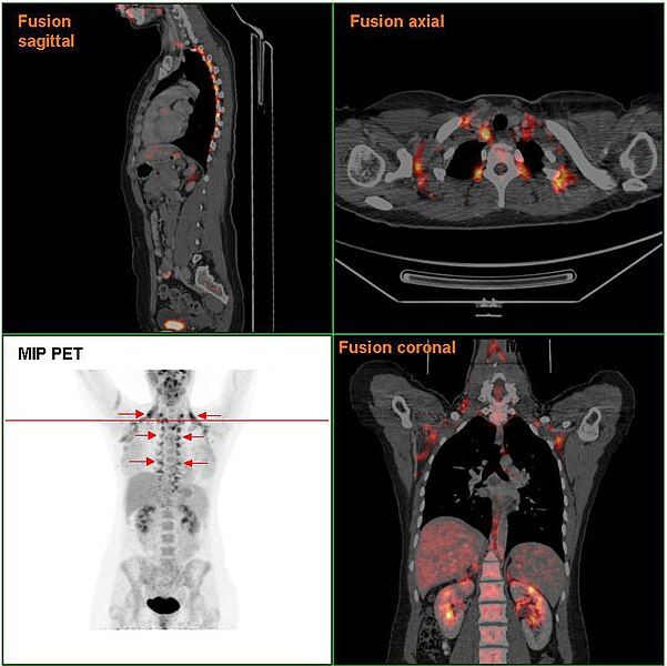 File:Brownfat PETCT.jpg