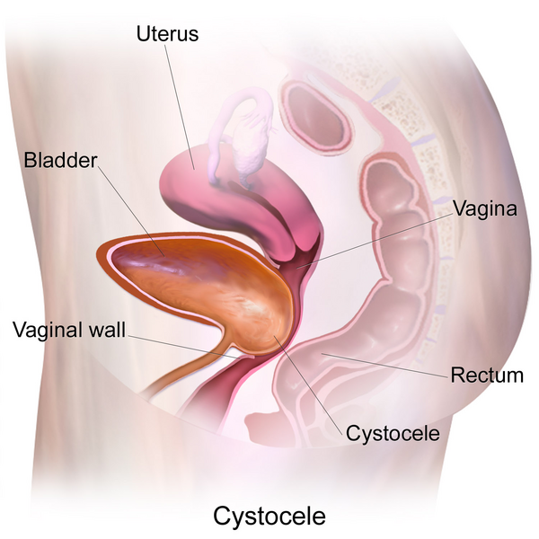 File:Cystocele.png