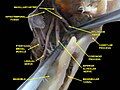 Infratemporal fossa. Lingual and inferior alveolar nerve. Deep dissection. Anterolateral view