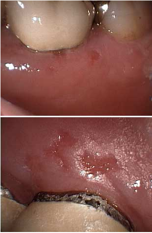 File:Herpes Gingivalis.tiff