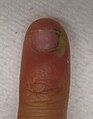 An infection of the cuticle secondary to a splinter