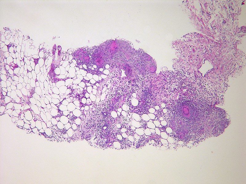 File:Tuberculous peritonitis (6544825621).jpg