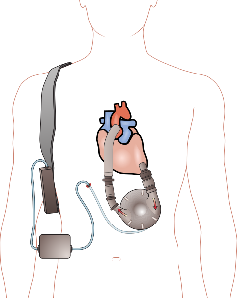 File:Ventricular assist device.svg