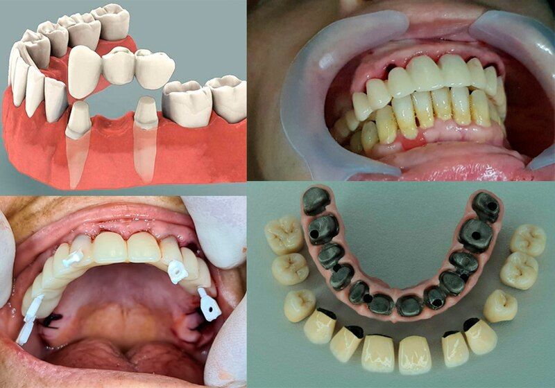 File:Dental prosthesis.jpg