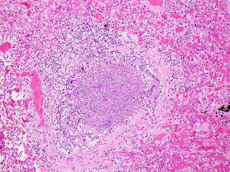 File:Acute bronchiolitis (8519105494).jpg