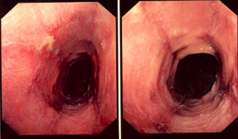 File:Lymphocytic esophagitis endoscopy.jpg