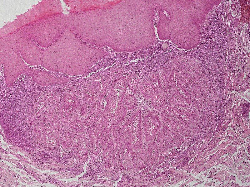 File:SkinTumors-P5280031.JPG