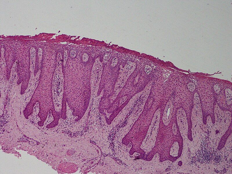 File:SkinTumors-P5280038.JPG