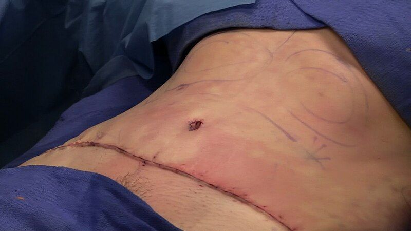 File:Abdominoplasty completely sutured.jpg