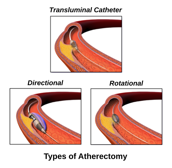 File:Blausen Atherectomy eng.svg