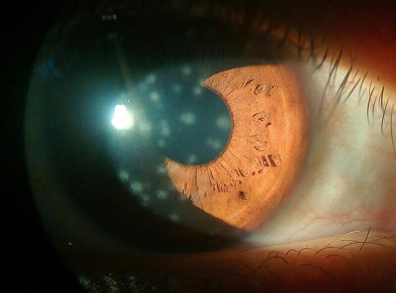 File:Adenoviral keratitis.jpg