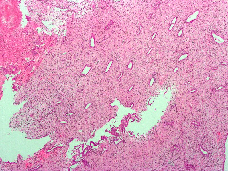 File:Endometrium ocp use0.jpg