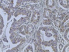 Immunohistochemistry of breast cancer (Infiltrating ductal carcinoma of the breast) assayed with anti HER-2 (ErbB2) antibody.