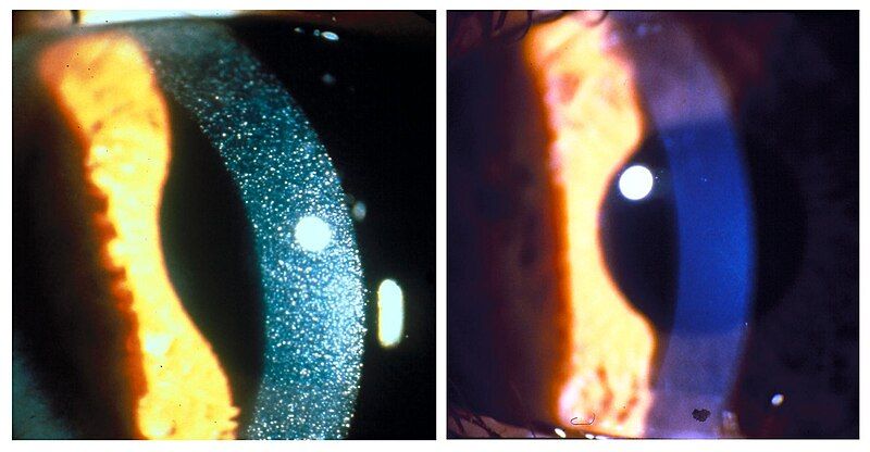 File:Nephropathic cystenosis NHGRI-79209.jpg