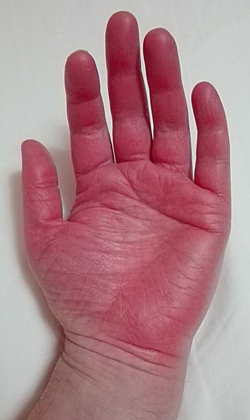 File:Erythromelalgia in hands.jpg