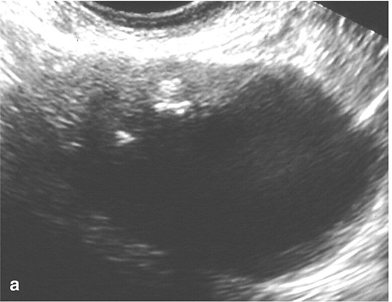 File:BT ultrasound.jpg