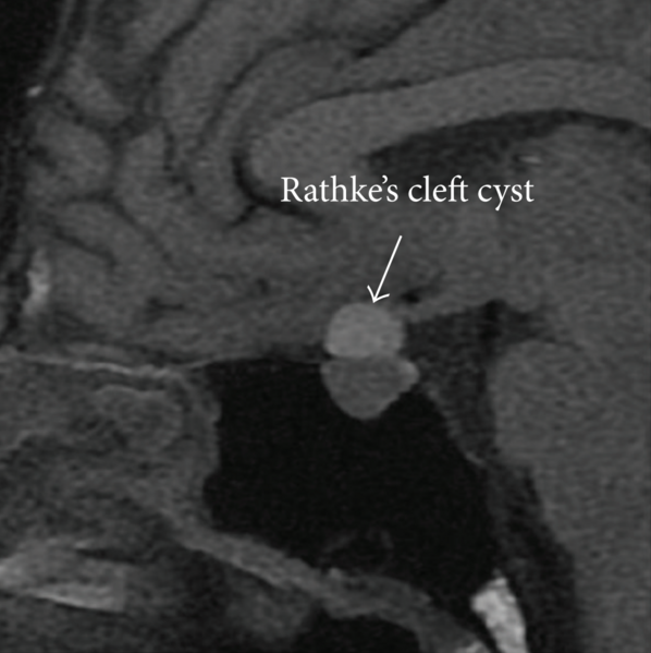 File:Rathke's cleft cyst.png