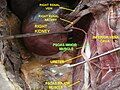 Psoas minor muscle