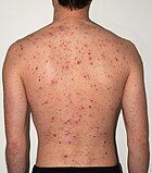 Chickenpox rash in an adult male