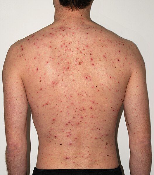 File:Chickenpox Adult back.jpg