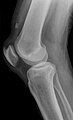 Quadriceps tendon rupture in plain X-ray