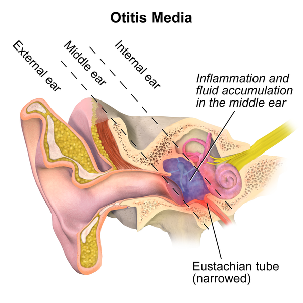 File:Otitis Media.png