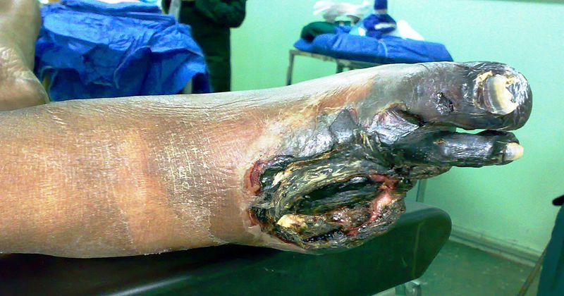 File:Gangrene Foot 01.jpg