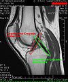 Cruciate ligaments