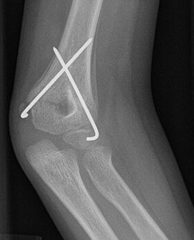 X-ray photograph of a fracture across the humerus, with a pair of wires crossed to pin the fracture